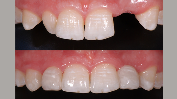 Beste Zahnrekonstruktion: 1. Platz geht nach Witten