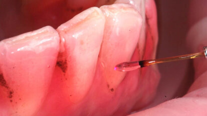 Laser e integratori di lattoferrina per il trattamento miniinvasivo delle black stain: case report