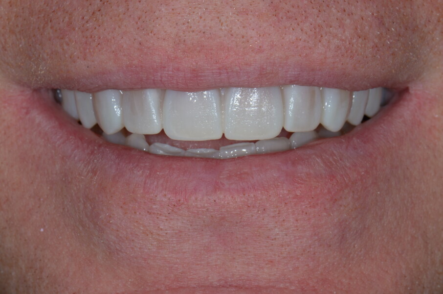 Fig. 4: Smile with mock-up.