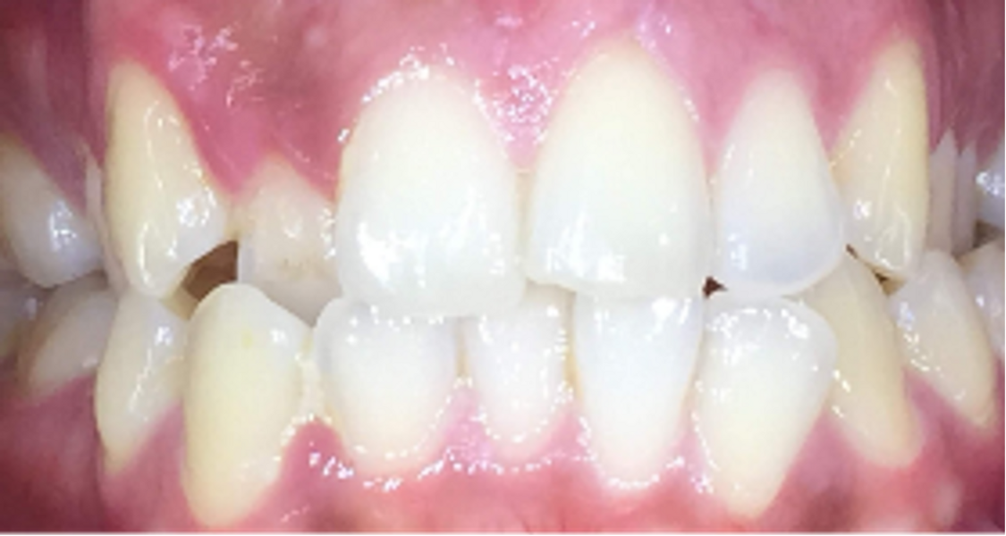Fig. 26: Close-up view of the patient’s smile.