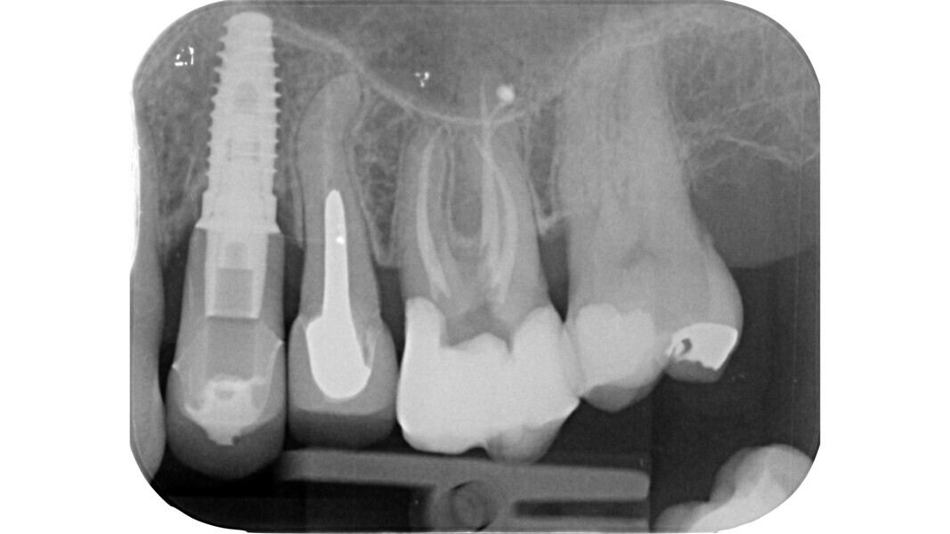 Fig. 33: Post-op radiograph