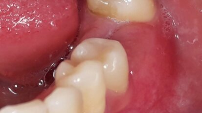 Incremento volumetrico dei tessuti molli sovracrestali in implantoprotesi mediante la tecnica “M.T.G”.