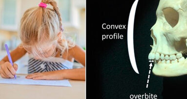 Uno studio conferma il collegamento tra volti scavati e mancinismo