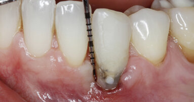 Management kosti a měkkých tkání při komplexní rekonstrukci jednoho zubu implantátem