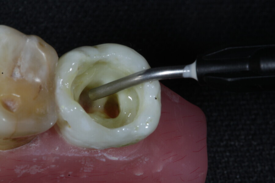 Fig. 23a: The space created by removing the gutta-percha is filled with a fibre-reinforced flowable composite (Fibrafill FLOW).