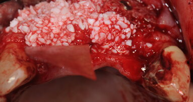 Utilizzo di L-PRF nelle procedure chirurgiche rigenerative: un caso clinico