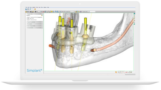 Simplant - guided surgery