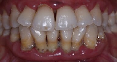 Linked: Low-level vitamin D, periodontitis and Type 2 diabetes.