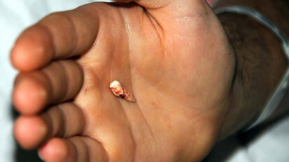 Burnundan Diş Çıktı!