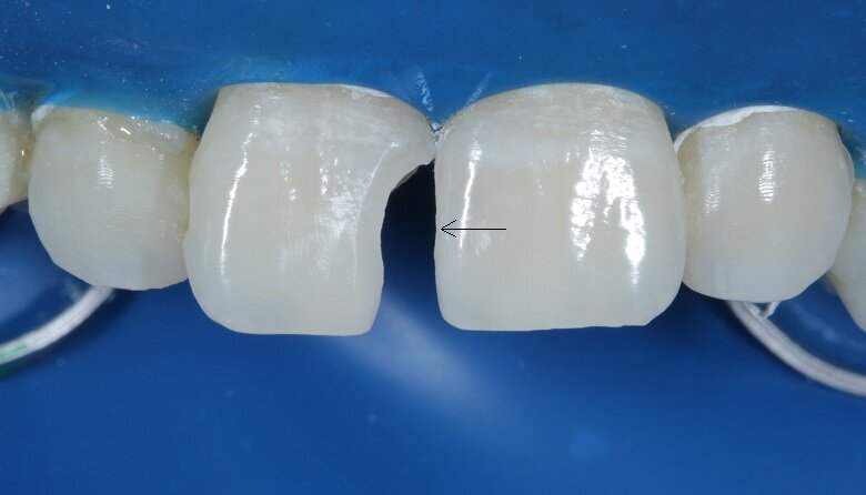 Fig 9: Enameloplasty done on 21