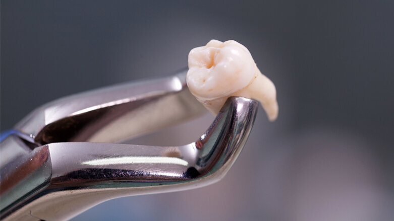 Studie belegt: Diabetes verursacht Zahnverlust