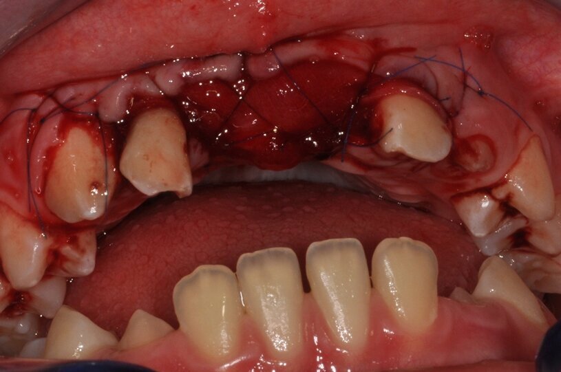 Ryc. 7_Stan miejscowy bezpośrednio po pierwszym zabiegu.
