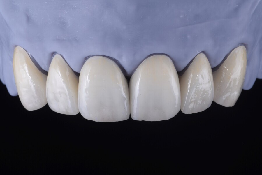 Figs. 14a & b: Final restorations.