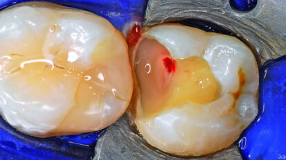 3D Endo Software, glide path management and WaveOne Gold