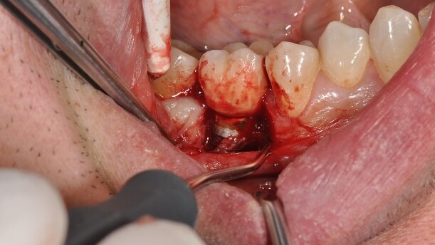 Rola higienistki w długofalowym prowadzeniu pacjenta implantologicznego