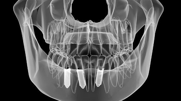 Учени са установили несъответствие между реалните и планираните имплантни позиции
