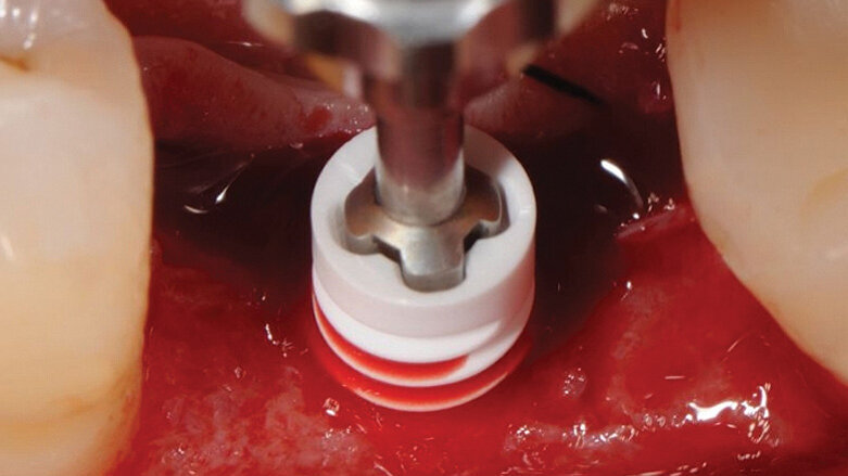 The next generation: Two-piece, metal-free screwed ZERAMEX XT