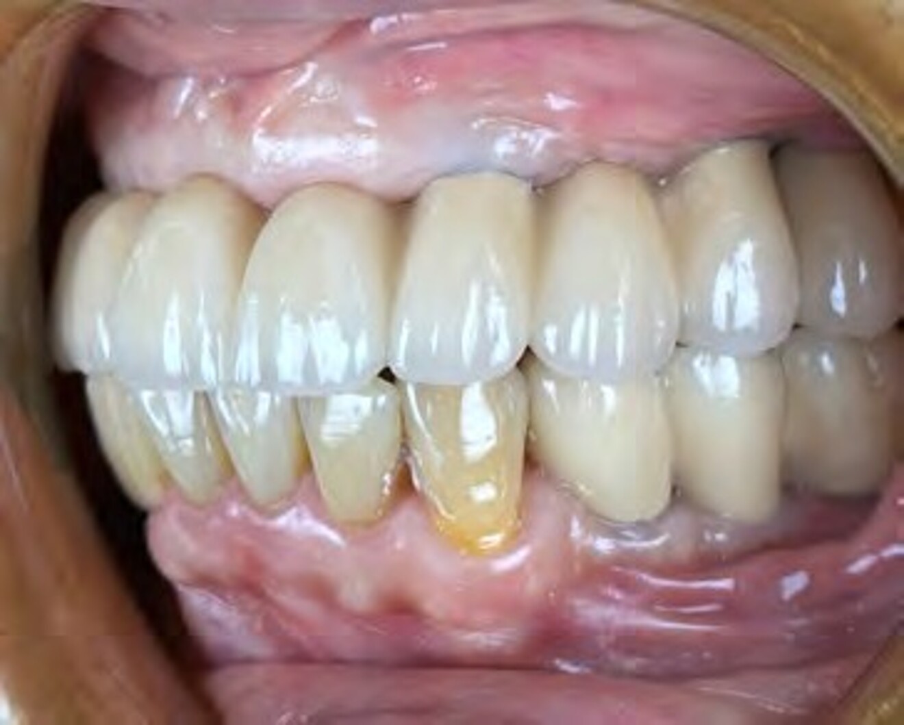 Fig. 3g: Left lateral intraoral view confirming harmonious occlusion and functional intercuspation after treatment. 