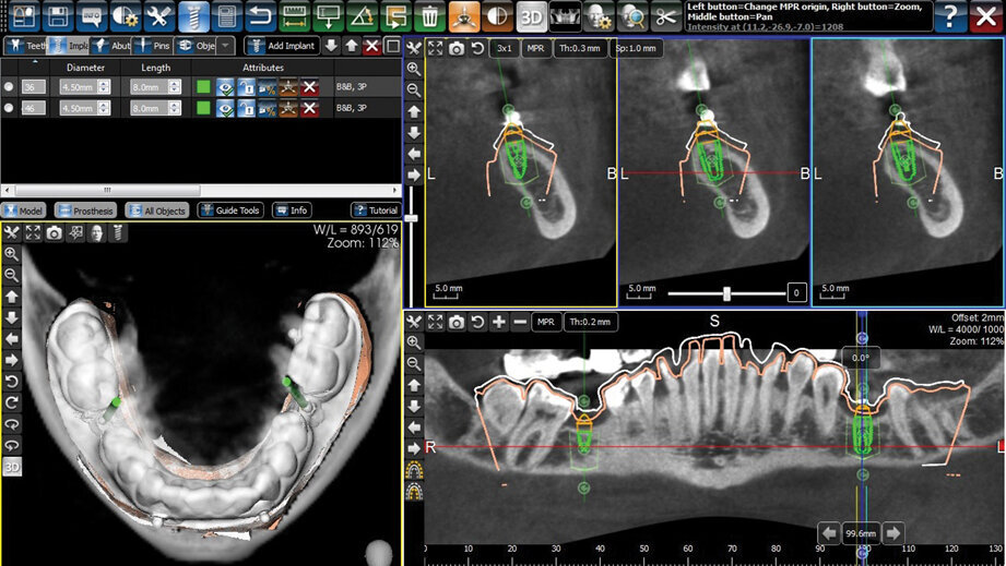 Ugradnja implantata upotrebom hirurškog stenta