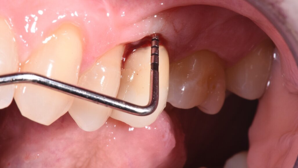 Trattamento non chirurgico della perimplantite. L’impiego di acido 5-aminolevulinico a supporto della TNC e il suo ruolo nella biostimolazione tissutale