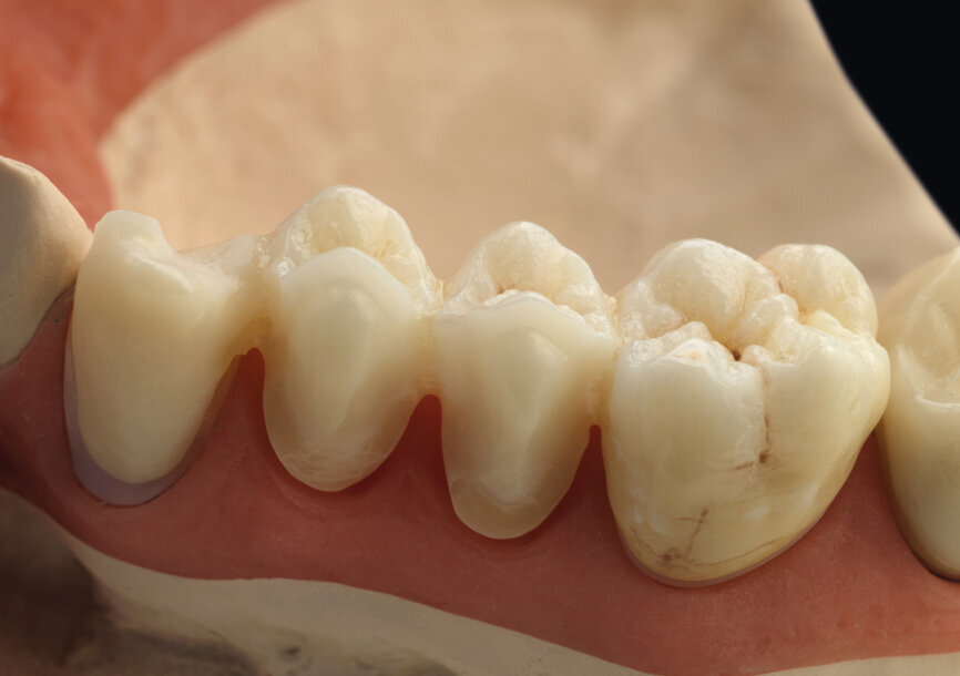 Zolid White wurde 2012 auf den Markt gebracht und war der allererste Rohling von Zolid. © Amann Girrbach