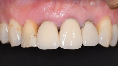 A fully guided digital workflow for predictable implant planning and placement