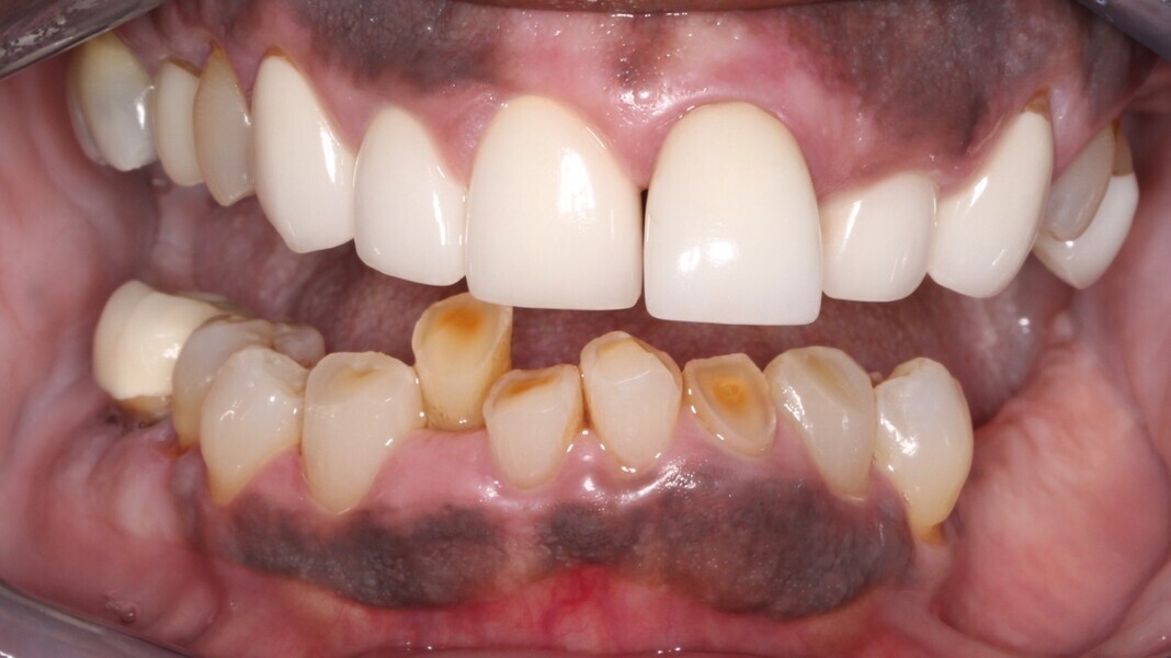 Fig. 5: Frontal view showing multiple aesthetic and functional deficits.