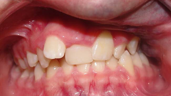 Face asymmetries in children and adolescents