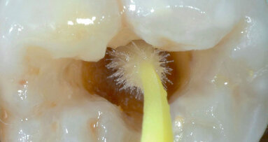 Výměna defektní distální výplně