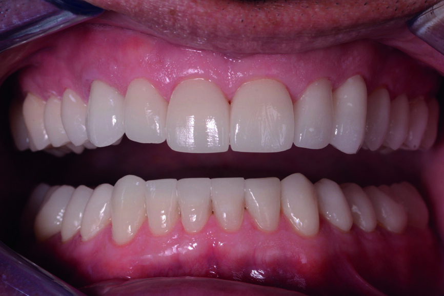 Figs. 13 et 14 : Photographies intraorales après le traitement. 