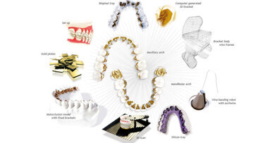 Trattamento non estrattivo di una II Classe  con incisivo centrale inferiore mancante mediante un sistema ortodontico linguale CAD/CAM