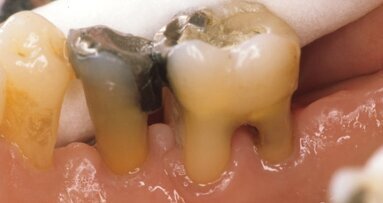 Kariogene bakterije proizvode supstance koje podstiču toleranciju na kalcijum