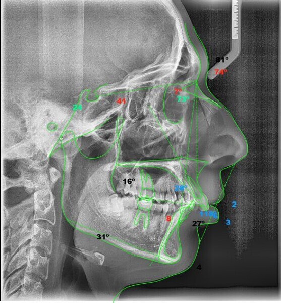 Fig. 5: Steiner cephalometric analysis (image generated using NemoCeph Studio).