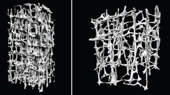Osteoporosi e bisfosfonati