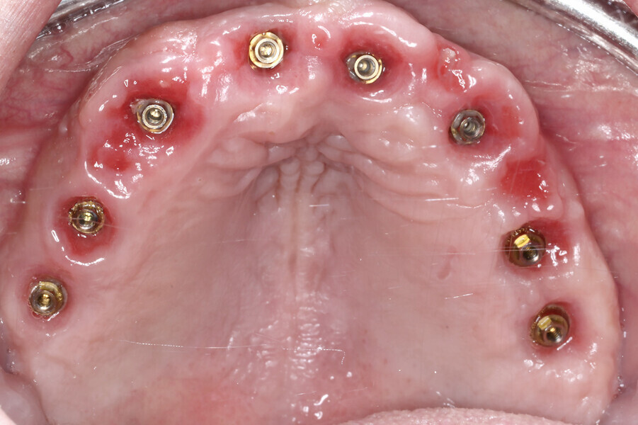 Fig. 5e: Intra-oral view of healed maxilla.