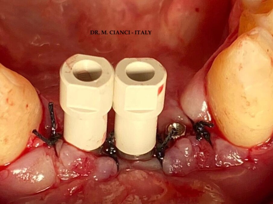 Fig. 8 - Scan body per impronta ottica.