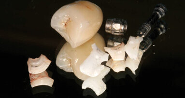 Precautions for using zirconia implant abutments