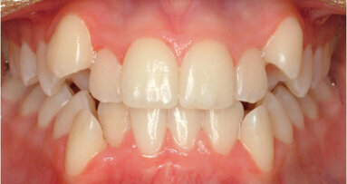 Why Dental Crowding Happens?