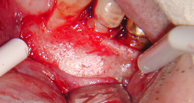 Predictable apical microsurgery: the incision and atraumatic flap elevation (Part 2) 