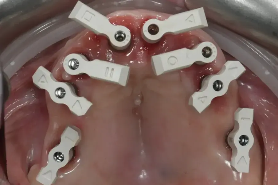 Фиг. 13: Сканиращи тела SmartFlag на място за интраорален отпечатък.