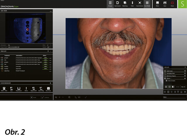 Nastavení individuálních parametrů konkrétního pacienta v programu Zirkonzahn.Archiv. V něm uložené údaje se importují do programu Zirkonzahn.Scan a dojde k fúzi dat.