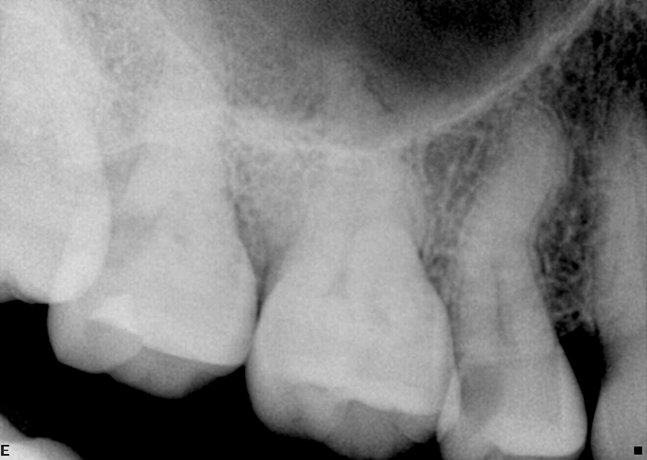 Case 1—Fig. 4: Initial periapical radiograph.