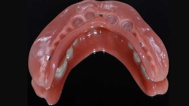 Rehabilitacja uzębienia za pomocą protez teleskopowych – opis przypadku