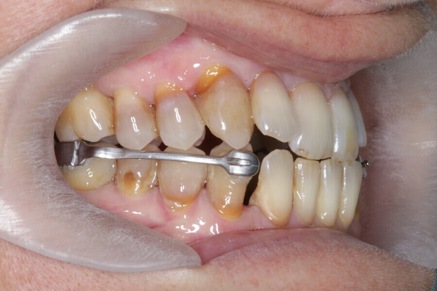 Fig. 34: Placement of the Carriere Motion 3D Class III appliance.