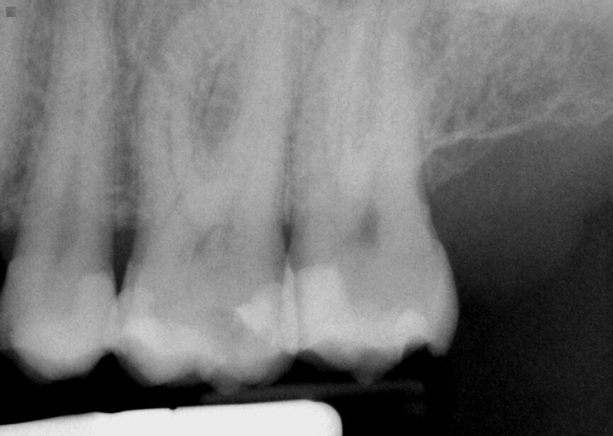 Fig. 14: Patient presented with complaint of pain on chewing on teeth 14 and 15 with increasing sensitivity to hot.