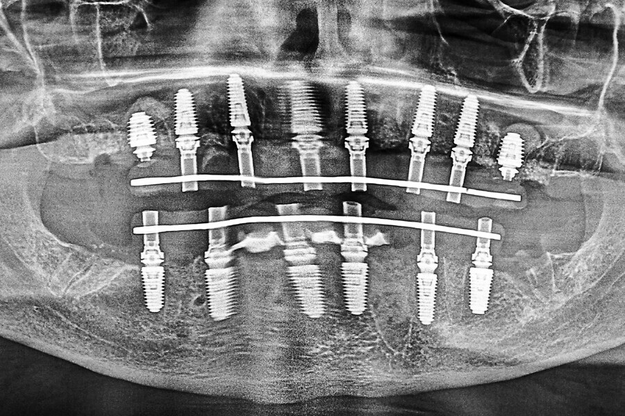 Fig. 14d: Retracted view of the provisional restorations (a) fabricated with C2F small hole technology (b). Two-week post-op smile (c). Two-week post-op panoramic radiograph and intra-oral photograph showing excellent healing (d & e).