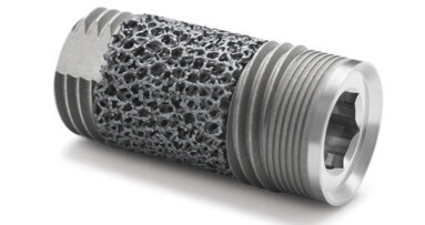 Clinical evidence reveals unique biological response to Trabecular Metal dental implant