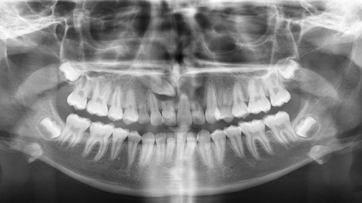 Preservación del tejido gingival en la rehabilitación implanto protésica postortodóncica