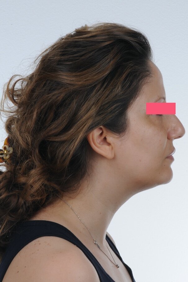 Figg. 1a-1c - Foto extraorali pre-trattamento: visioni frontale, frontale del sorriso e laterale.