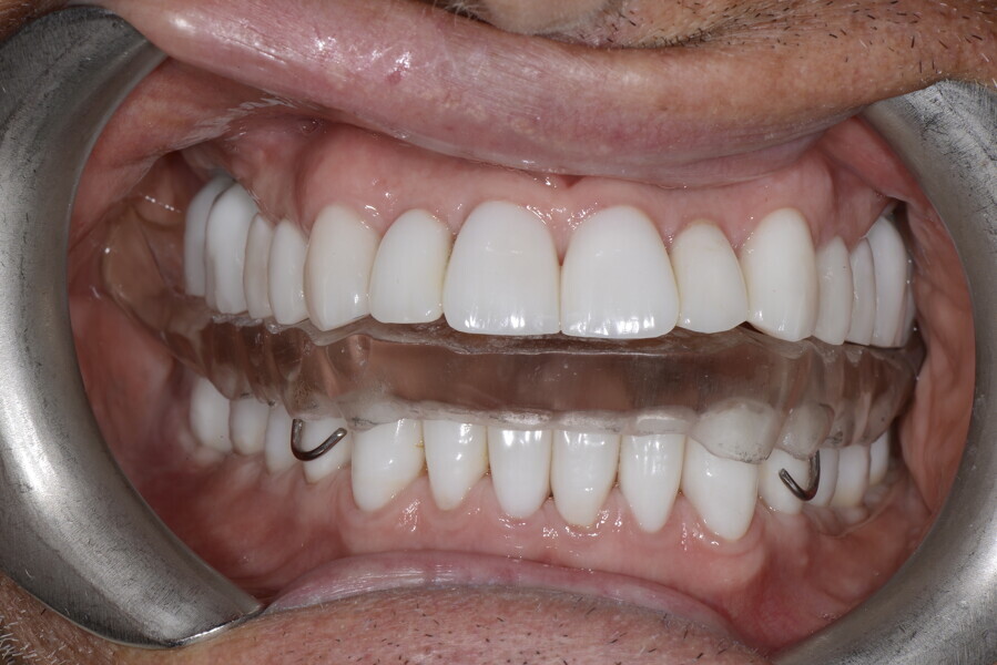 Figs. 29a–e: Dr Maurizio Reali’s occlusal splint, useful for protecting the teeth but mainly to improve disclusion dynamics with pos- terior balancing contact to sustain and reduce overload of the temporomandibular joints.